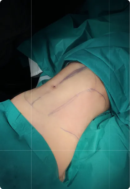 LIPosuction