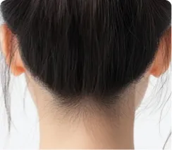 Occipital Augmentation Surgery