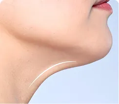 Submental Liposuction